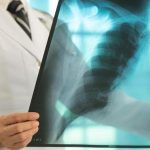 Erken tanı hayati önem taşıyor! Akciğer kanserinin belirtileri ne? Öksürük, göğüs ağrısı, halsizlik, kanlı balgam… –